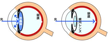 白内障の手術内容