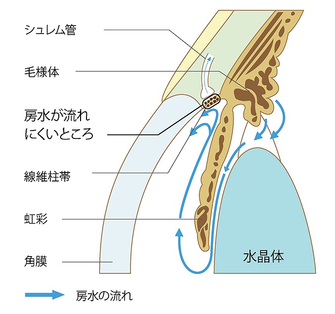 眼圧が正常な緑内障も