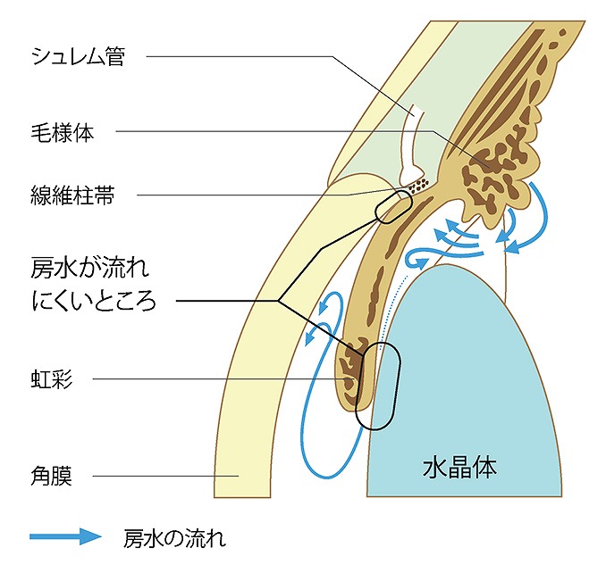 眼圧が正常な緑内障も