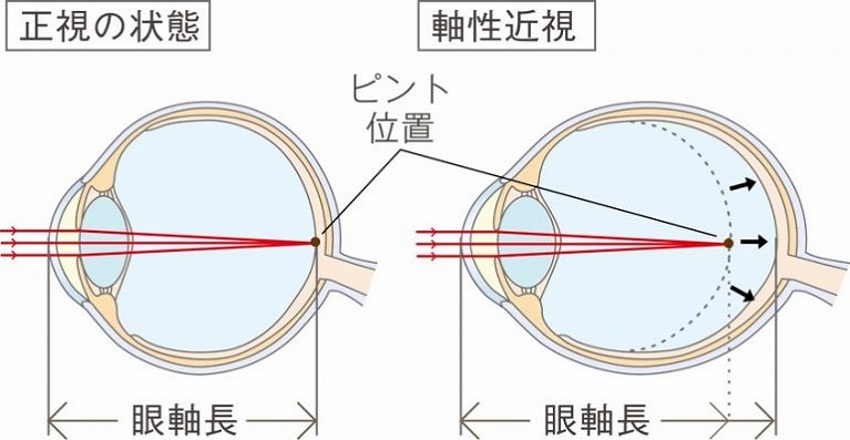 こどもの近視