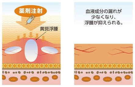 抗VEGF薬治療（硝子体内注射）当院ではルセンティス・アイリーアを使用しております