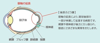 強度近視（病的近視）とは