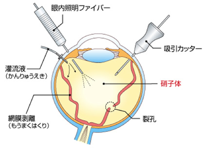 網膜・硝子体日帰り手術