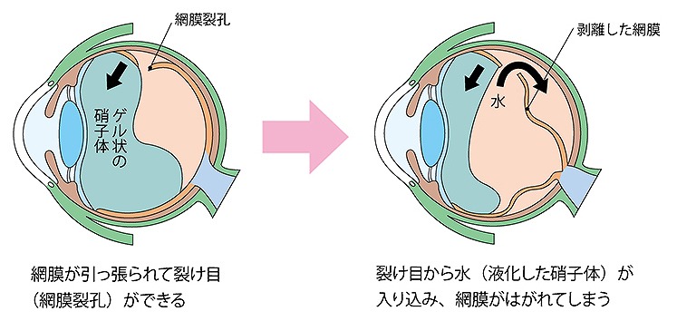 網膜剥離