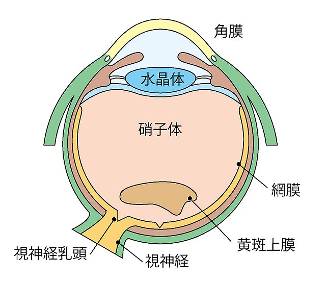 黄斑前膜（黄斑上膜）